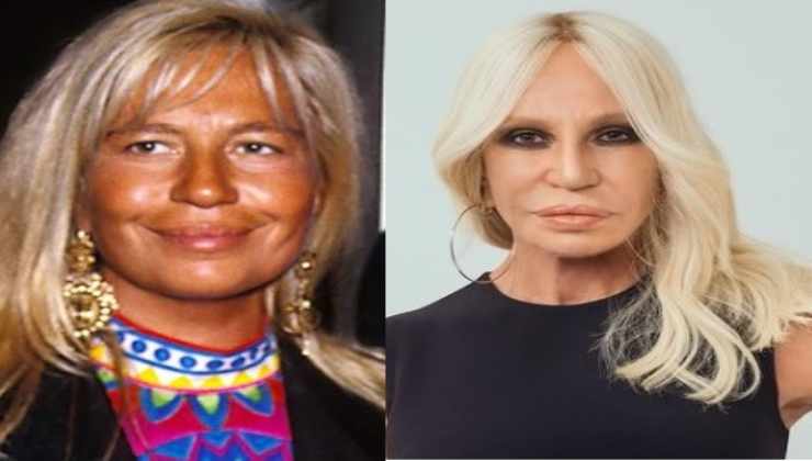 Donatella Versace chirurgia estetica