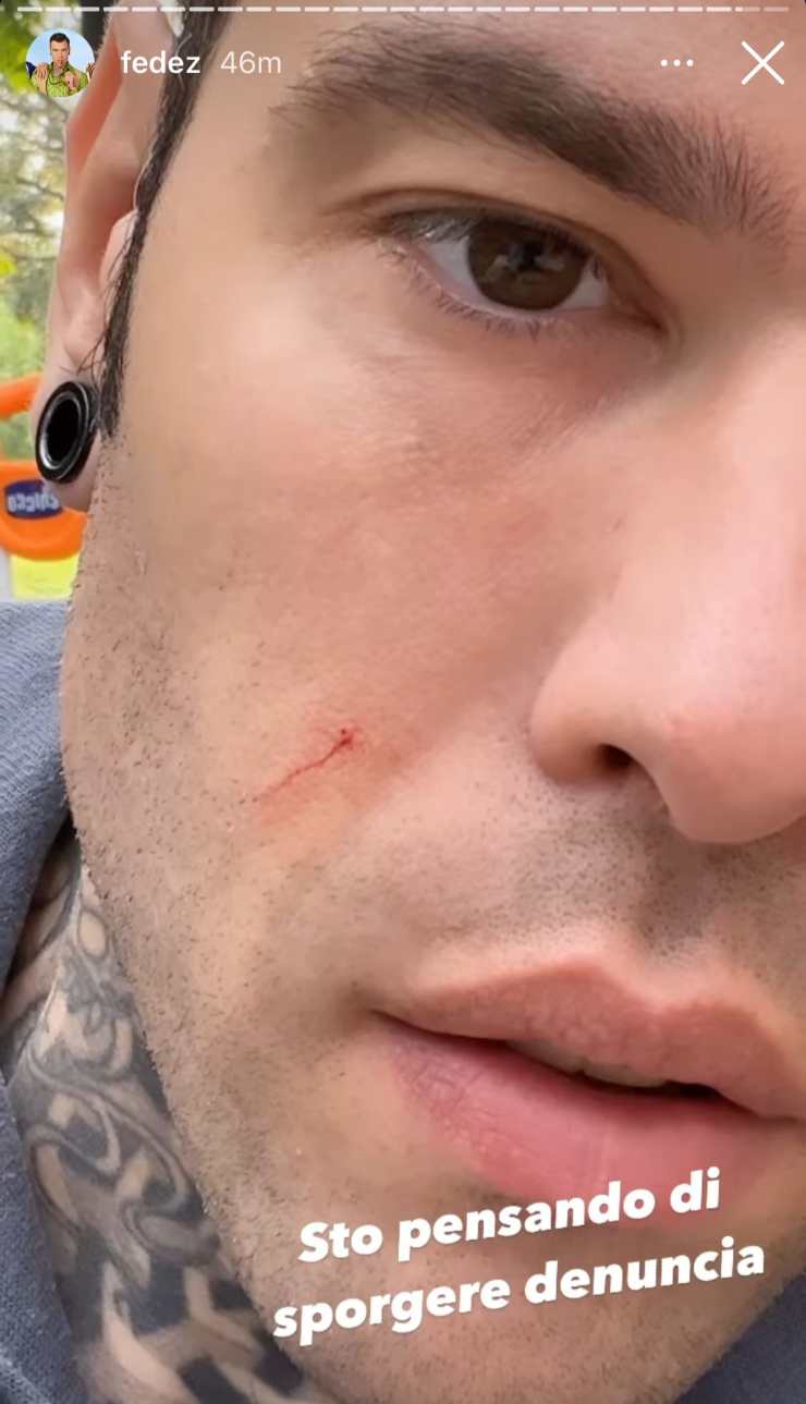 Fedez ed il segno sul viso - Political24 